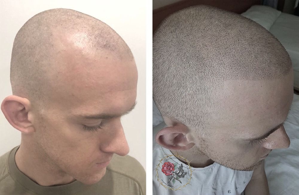 Permanent shaved head