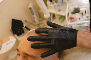 Лосьон Элоком для волос при алопеции – отзывы