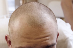Не стоит делать трихопигментацию в клиниках по пересадке волос