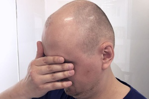 Трансплантация собственных волос головы – отзывы мужчин