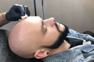 Пересадка волос на голове у мужчин 