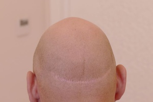 Не стоит делать трихопигментацию в клиниках по пересадке волос