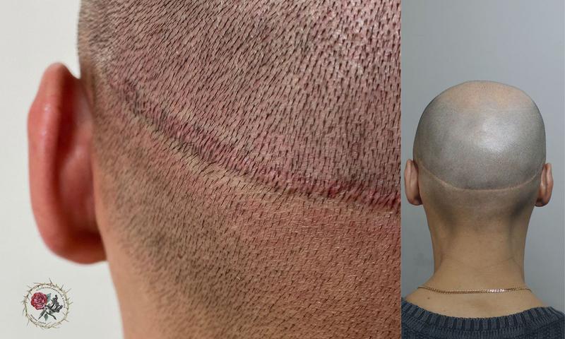 scalp scalp micropigmentation before after