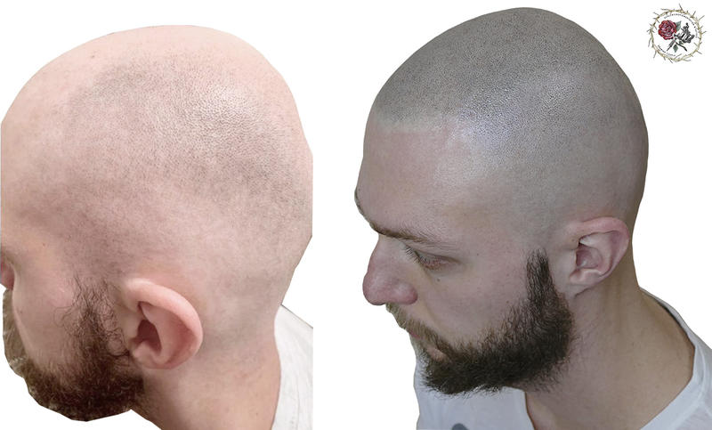 Фото трихопигментации,тату волос, фото до и после процедуры
