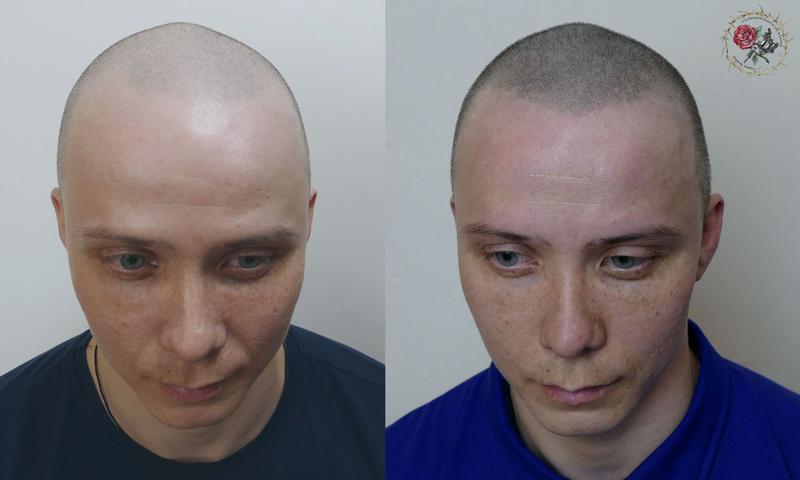 маскировка поредения волос у мужчин