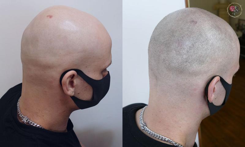 scalp micropigmenttion before after