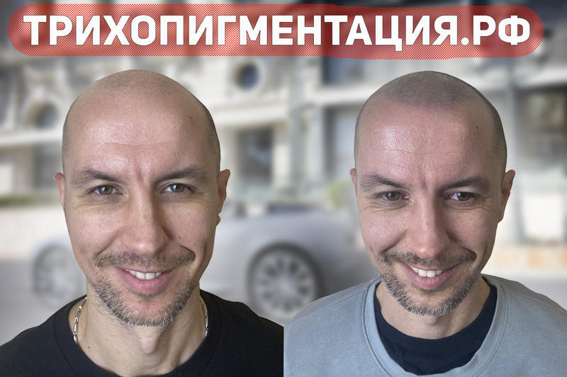 Фото трихопигментации,тату волос, фото до и после процедуры