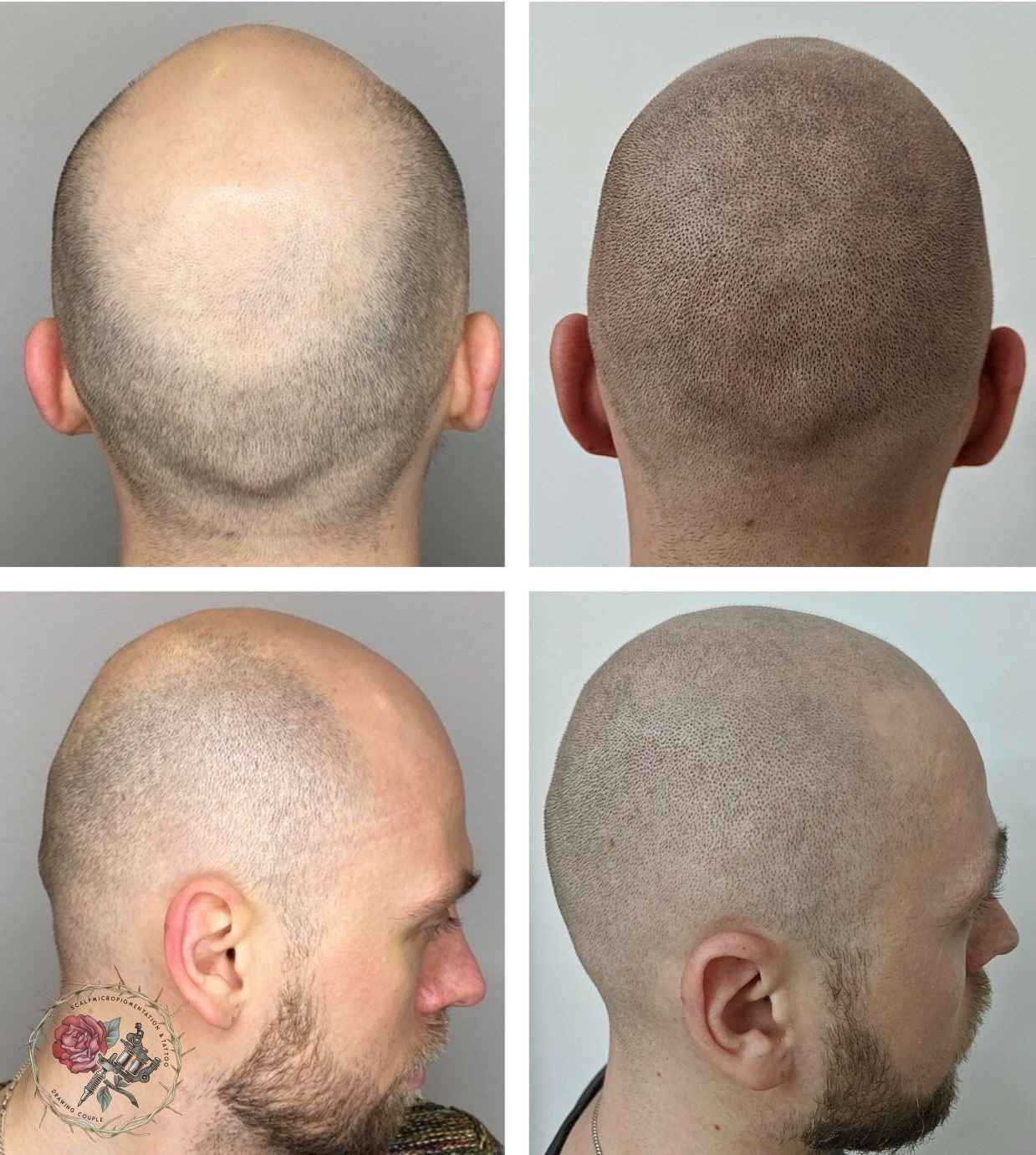 Трихопигментация татуировка волос отзывы мужчин